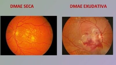 DEGENERACION MACULAR ASOCIADA A LA EDAD